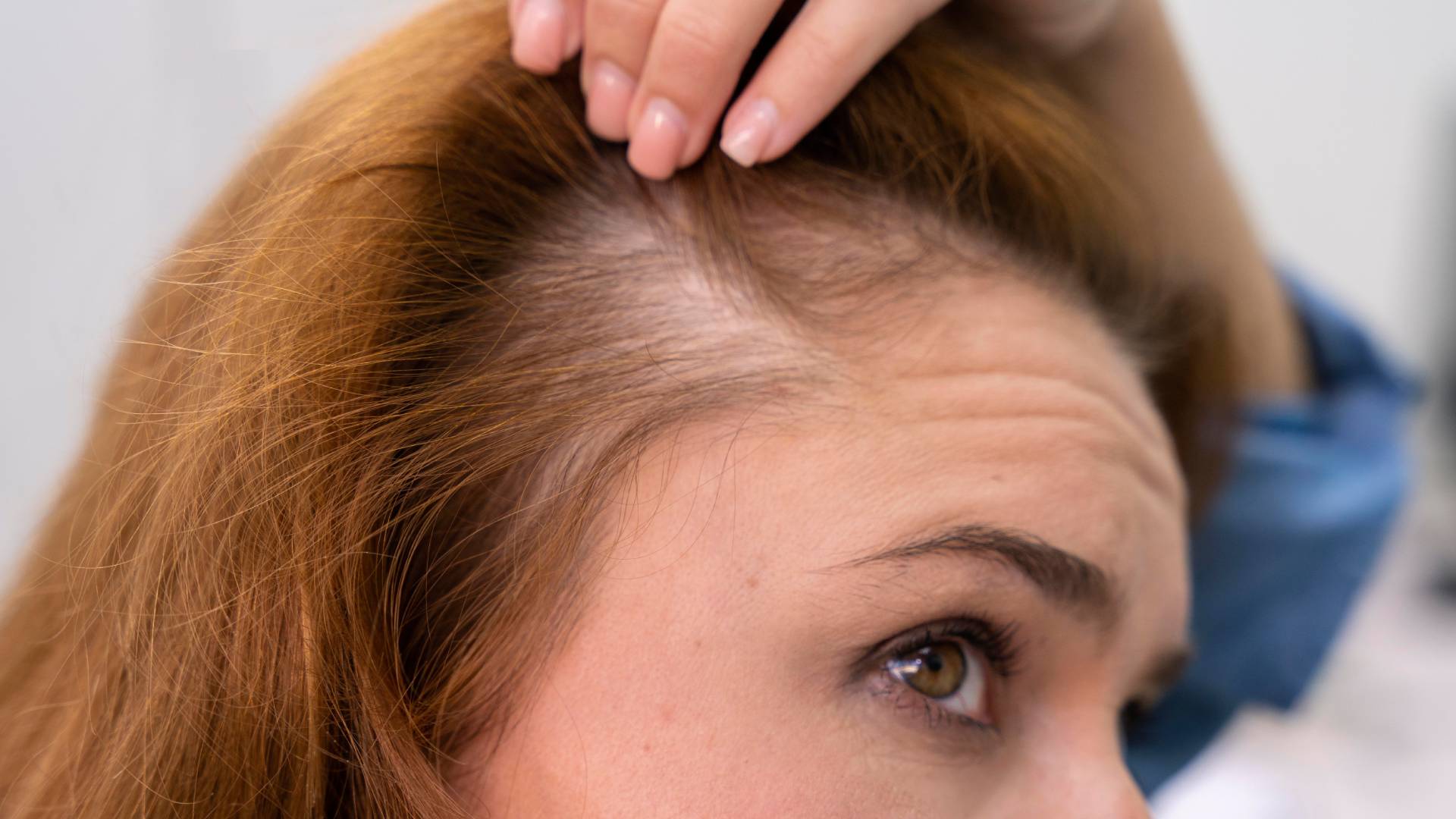 Alopesi (Saç Dökülmesi)