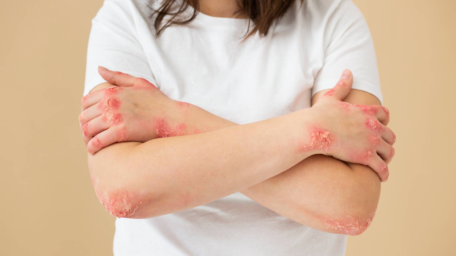 Döküntülü Cilt Hastalıkları