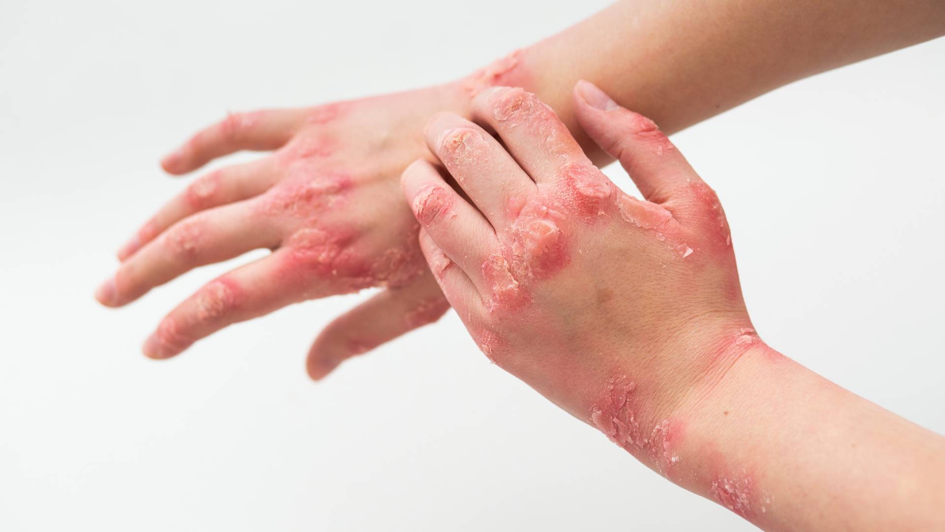 Akne Rozasea (Gül Hastalığı) 