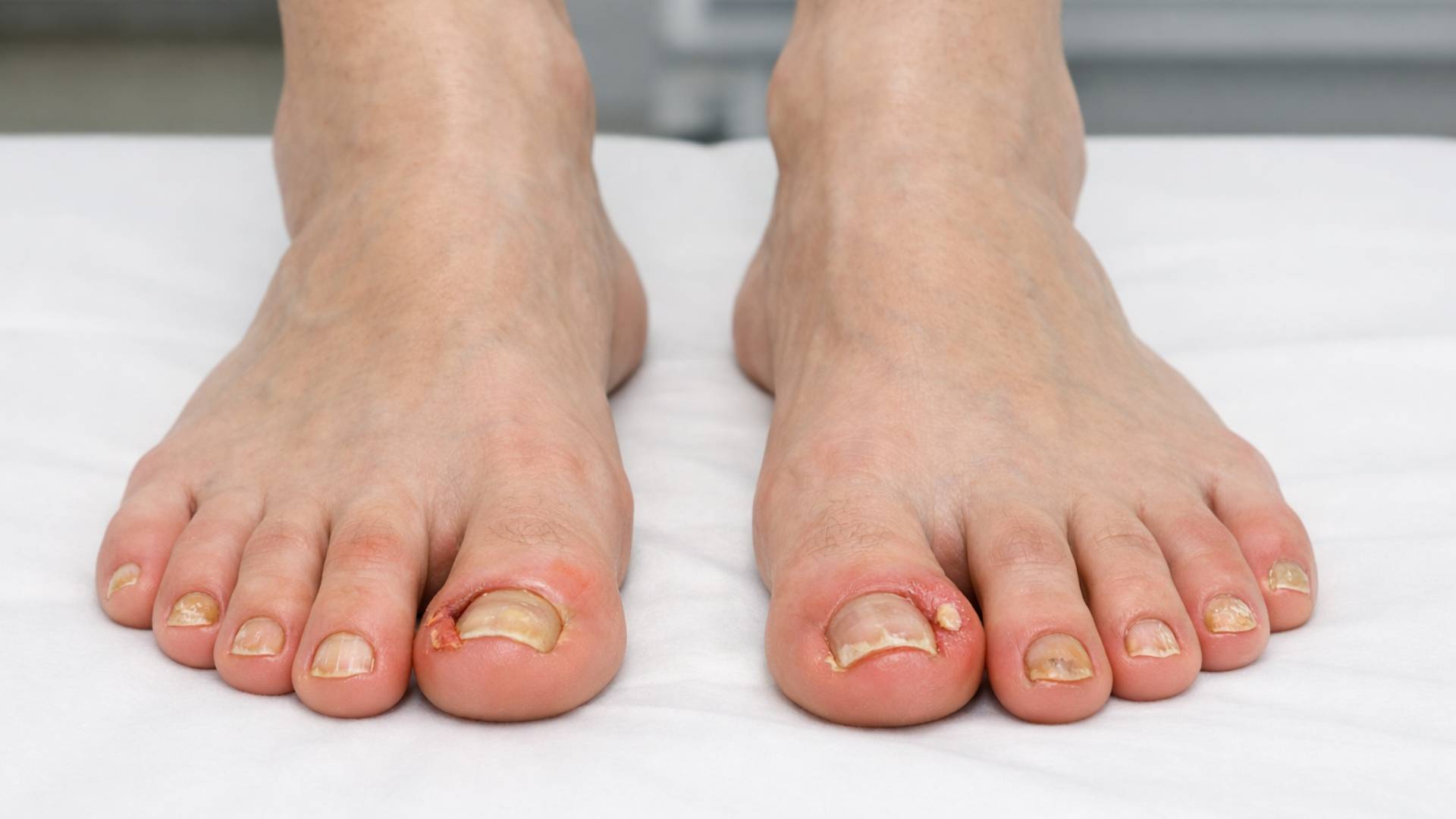 Tırnak Batığı ve Tırnak Hastalıkları