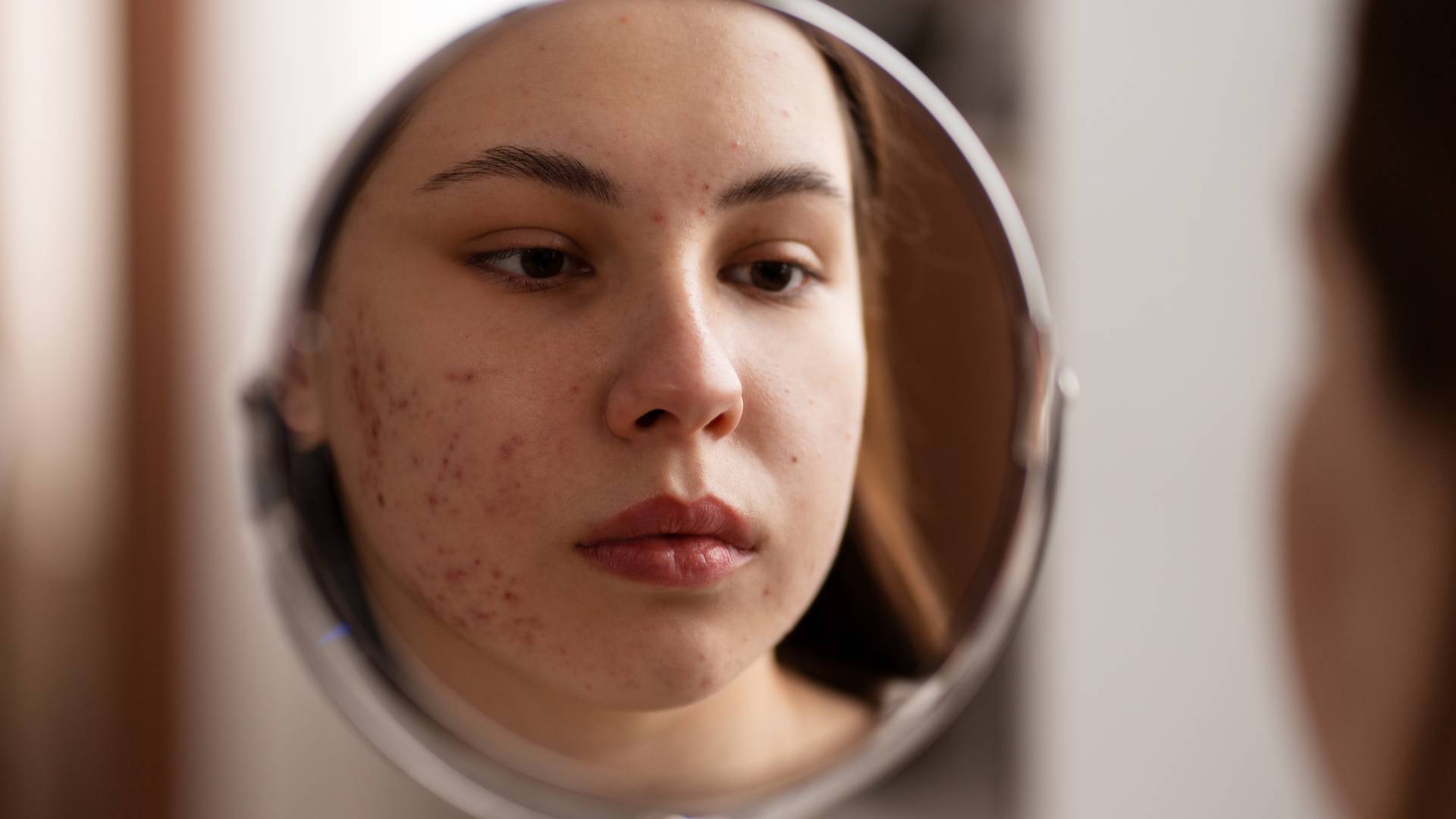 Akne Ve Akne İzi Tedavisi 